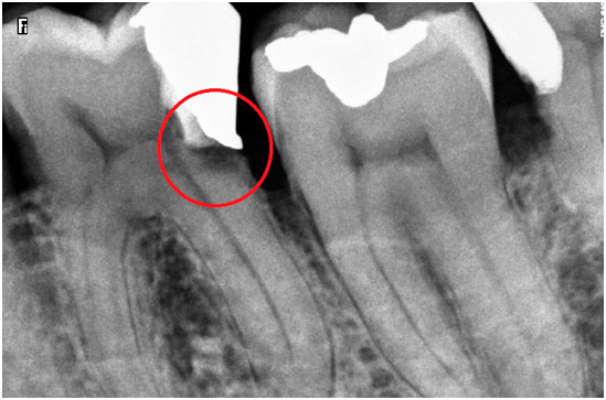 ¿Qué es un endodoncia?, ¿Para qué sirve?
