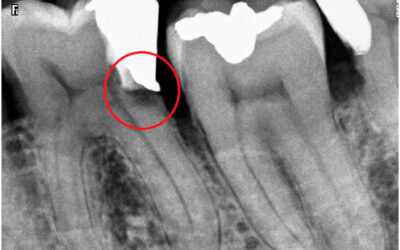 ¿Qué es un endodoncia?, ¿Para qué sirve?